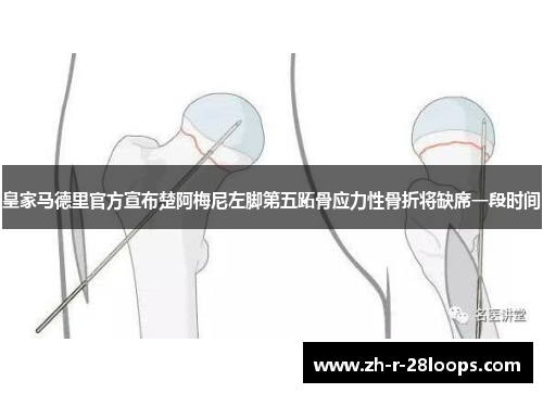 皇家马德里官方宣布楚阿梅尼左脚第五跖骨应力性骨折将缺席一段时间